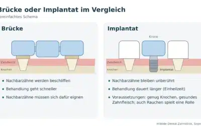 Brücke oder Implantat? Eine Entscheidungshilfe für die Zahnlücke